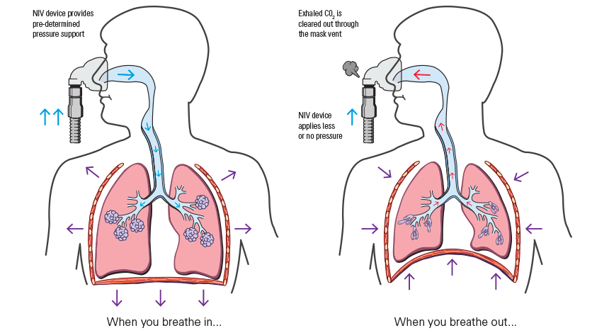 non-invasive-ventilation-for-copd-can-it-help